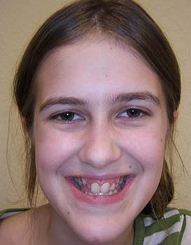 Braces Before & After | Bubon Orthodontics | Southern WI Orthodontist