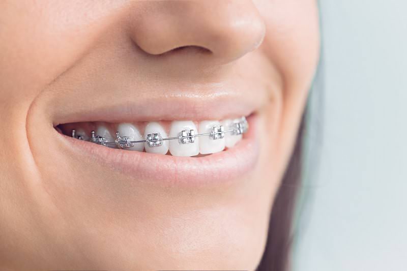 Un)Traditional Braces, Colored Metal Braces in Milwaukee WI, Beloit WI,  and Roscoe IL