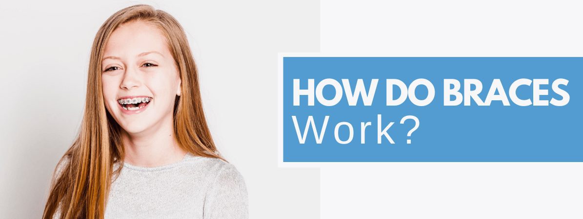 how do braces work