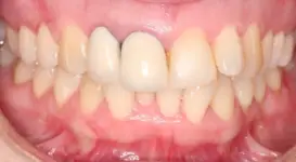 Charmine Before DPO