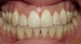 Elizabeth After Teeth