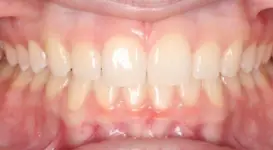 Karolina After teeth