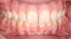 Karolina Before teeth