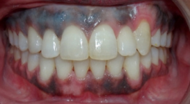 Sarah After DPO Teeth