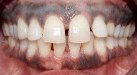 Sarah Before DPO teeth